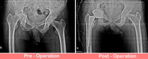 Acetabular Fracture – Uncemented THR