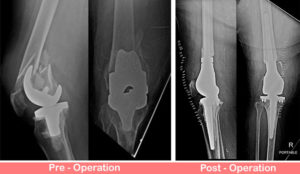 Distal Femur Replacement