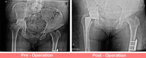 Primary Complex Total Hip Replacement
