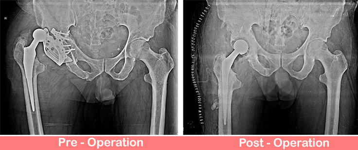 Re-Revision Complex Total Hip Replacement