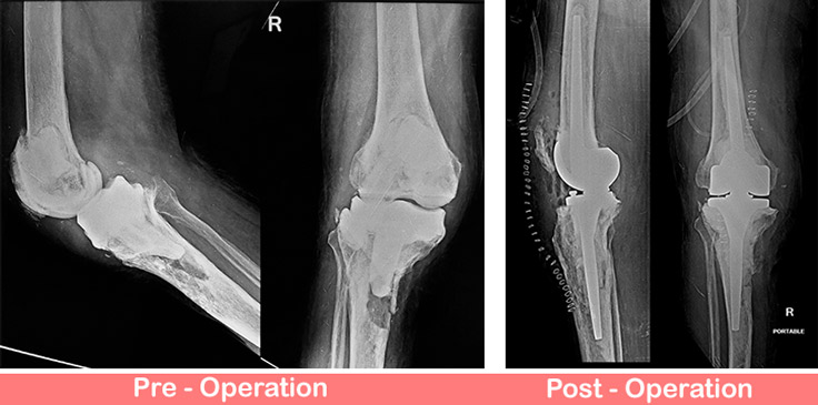 Revision-Total-Knee-Replacement-Rotating-hinge-Knee