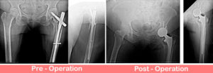 Total Hip Replacement Dual Mobility