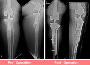 Revision Total Knee Replacement (Rotating Hinge Knee)