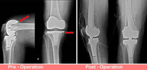 Revision Total Knee Replacement