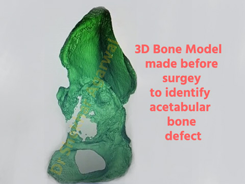 3D Bone Model made before surgey to identify acetabular bone defect
