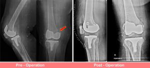 Periprosthetic Fracture right knee