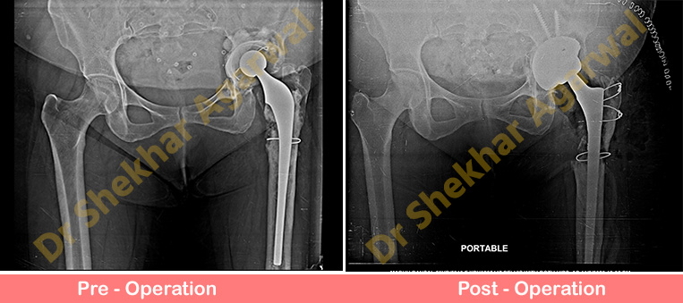 Re-Revision Total Hip Replacement X-Ray