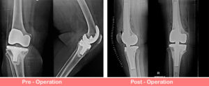 Revision Total Right Knee Replacement