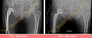 Revision Total Hip Replacement (THR)