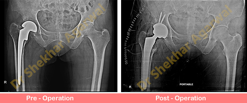 Revision Total Hip Replacement (THR)