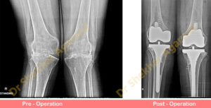 Primary Complex Total Knee Replacement ( Valgus Knee )