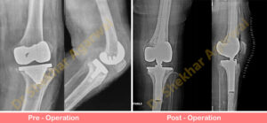 Revision Knee Replacement (RHK)