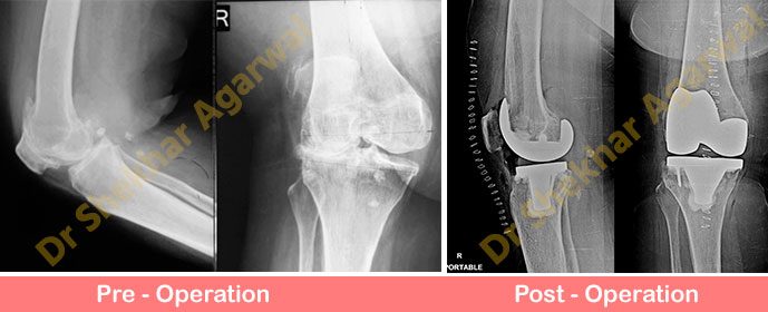 primary-complex-knee-replacement