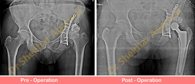 Primary Complex Total Hip Replacement (THR)