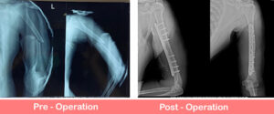 Fracture shaft of humerus