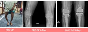 Primary complex Total Knee Replacement