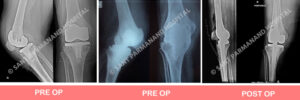 Revision Total Knee Replacement