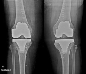 Robotic Knee replacement R Portable