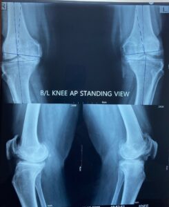 Delhi's first Robotic Knee replacement