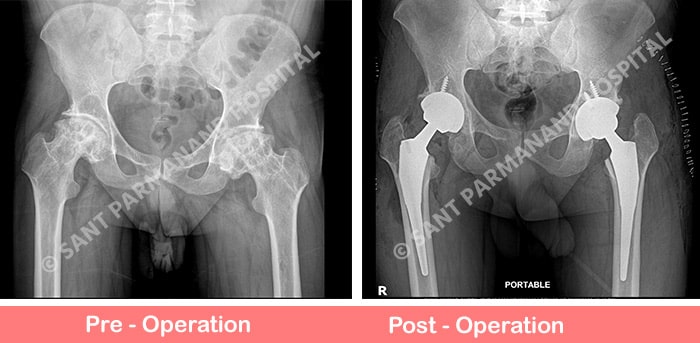 Bilateral-Total-Hip-Replacement