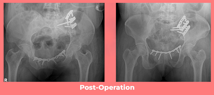 Complex Pelvi -Acetabular Injury