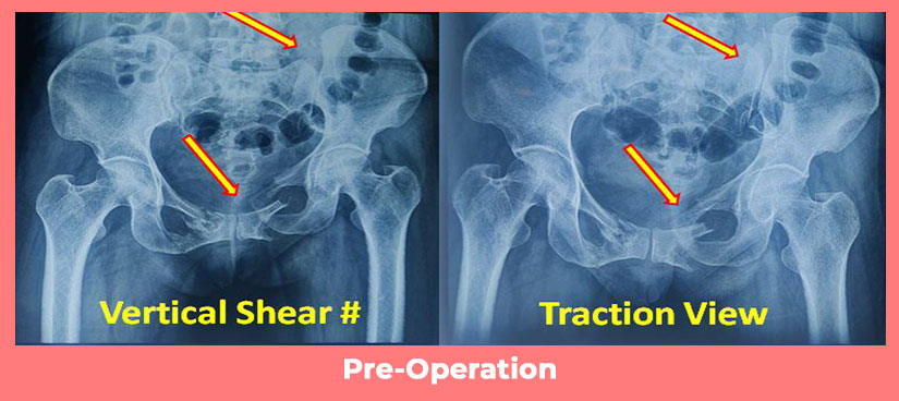 Complex Pelvi -Acetabular Injury