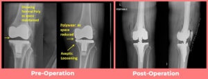 Revision Knee Replacement surgery